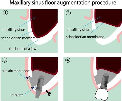 Ridge and Sinus Augmentations