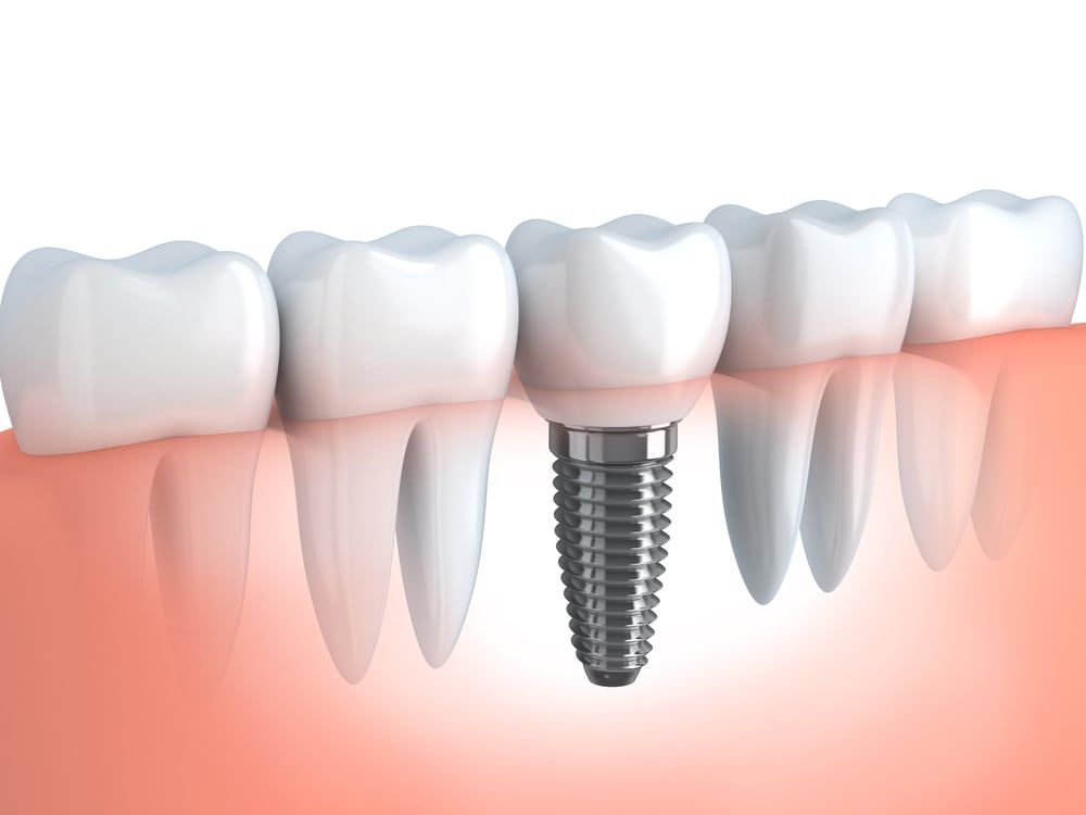 Dental Implants by Oral Surgeons